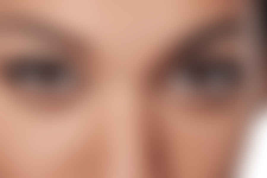 Botox for strabismus treatment